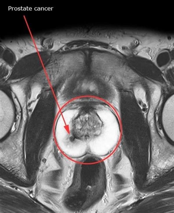 Tổng quan về kỹ thuật cộng hưởng từ tuyến tiền liệt  đa thông số (multi-parametric MRI)